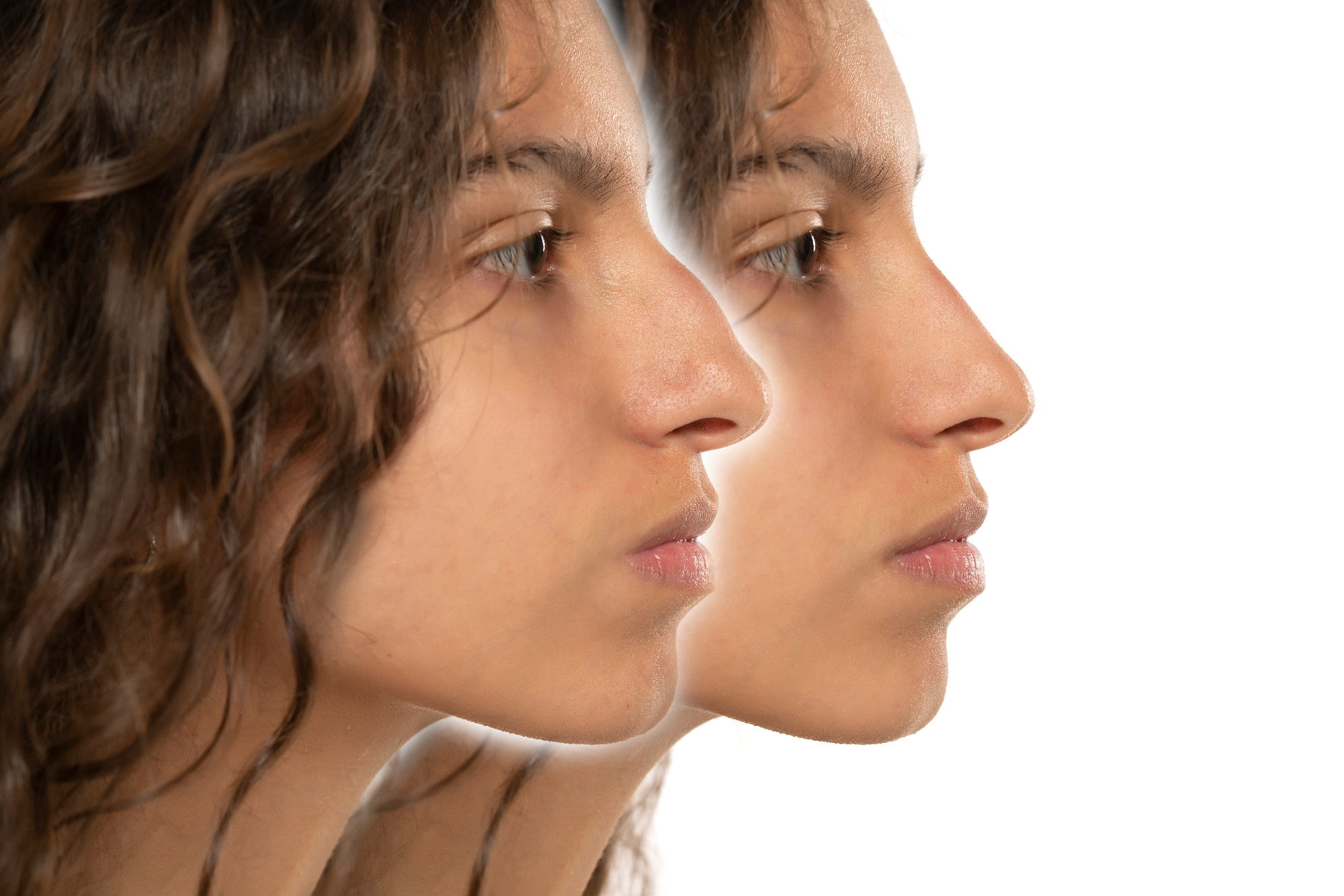 Iz kojih se sve razloga rinoplastika može izvoditi?